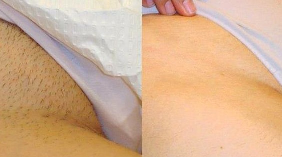 Zdjęcia przed i po depilacji Vectusem